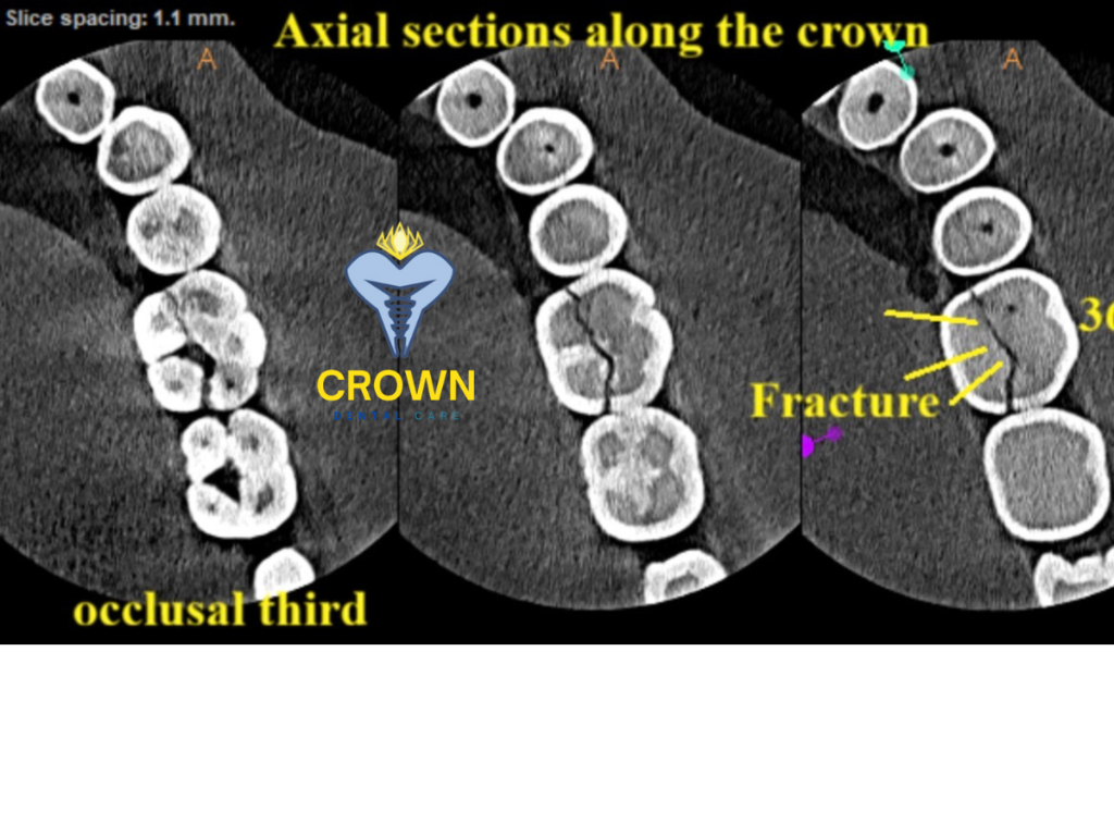 Radiographic view of fracture