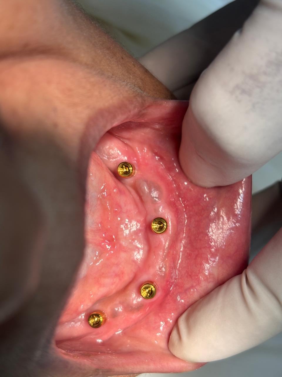 Implant Placement
